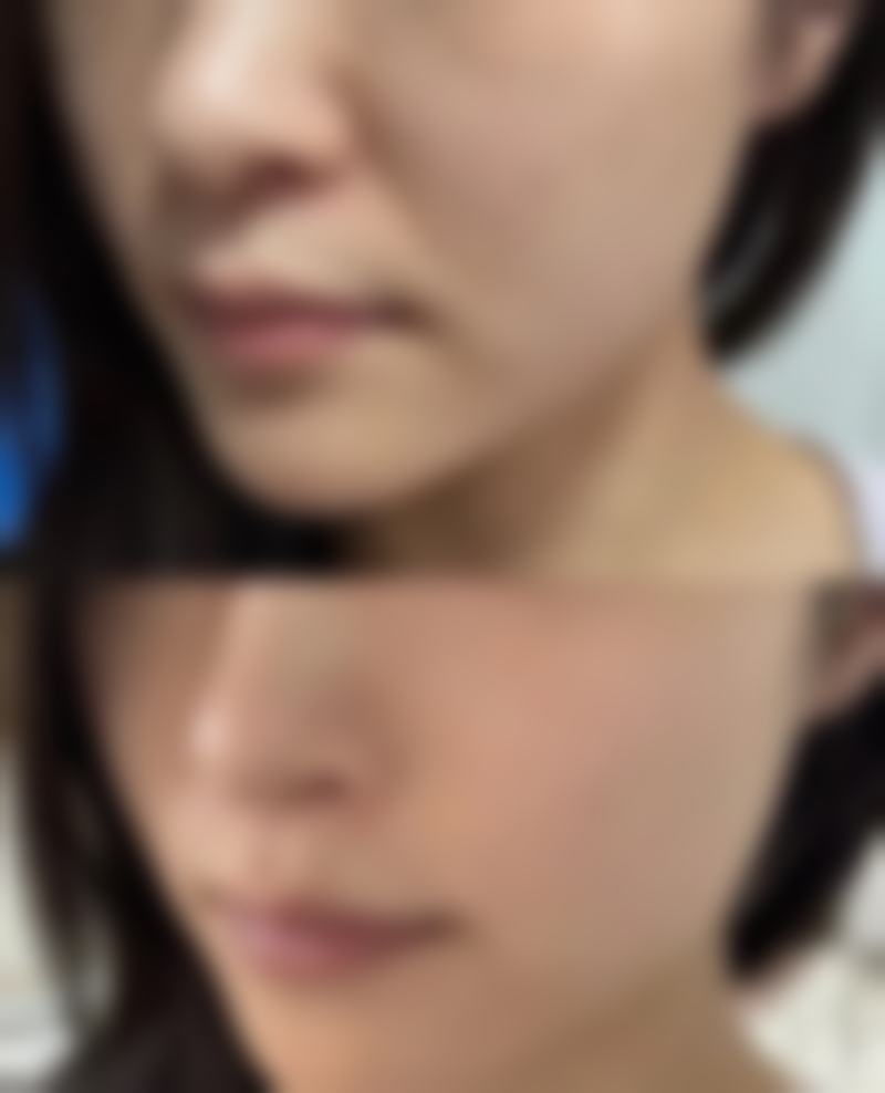 被鼻小柱问题困扰？达州妃美诊所矫正，原价6800 - 9800元，定制方案助你美鼻！ 