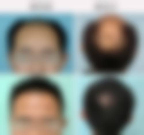 牛改医生的核心植发技术