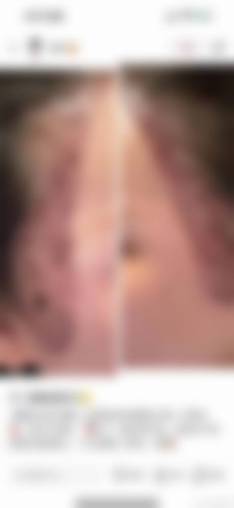 牛改医生擅长的毛发移植技术