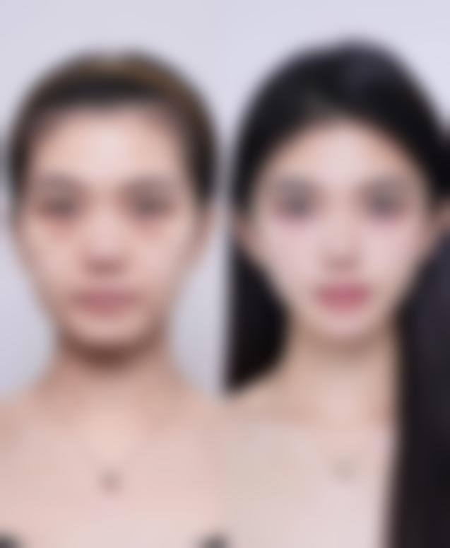 苏爱云医生的自体脂肪与祛疤技术