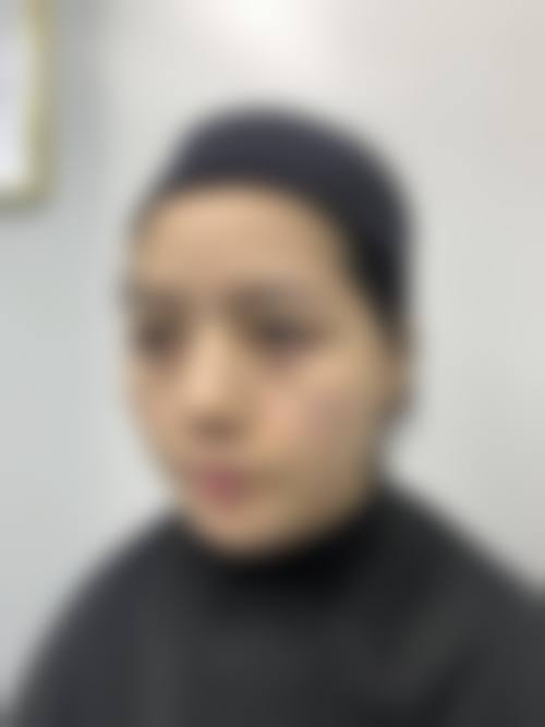 马满仓医生擅长的去眼袋技术