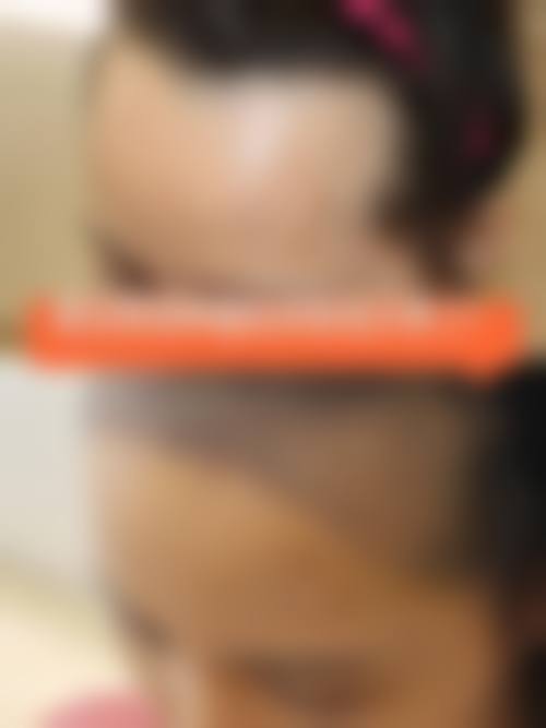 太原大麦微针植发诊所求美者反馈