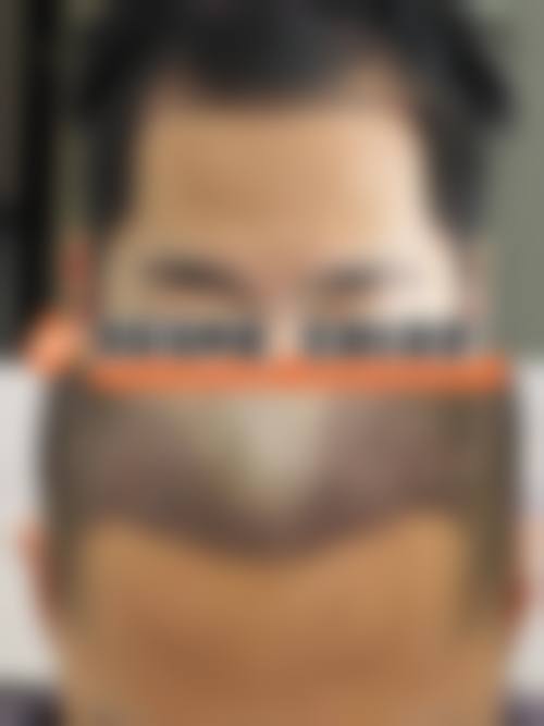 海口碧莲盛植发怎么样特色项目及技术优势