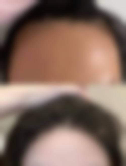 海口碧莲盛植发怎么样价格收费