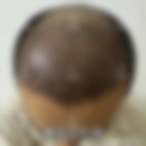 海口碧莲盛植发怎么样求美者反馈