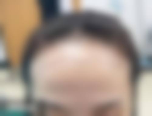 沈阳华美医院植发中 心怎么样价格收费