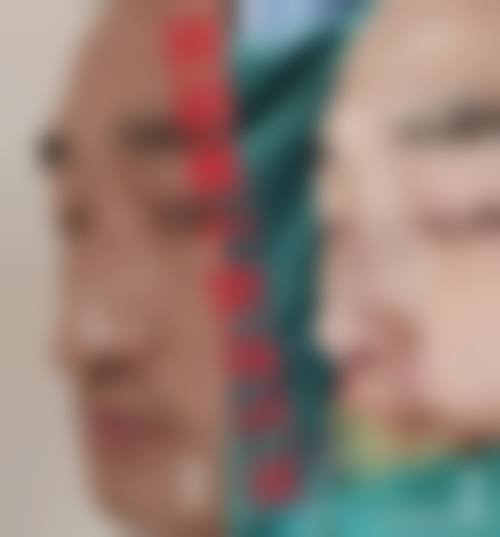 韩国鼻整形研究所价格收费