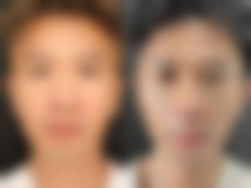 韩国鼻整形研究所求美者反馈