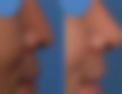 韩国鼻整形研究所特色项目及技术优势