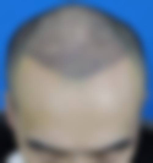 米圣医生临床应用的核心无痕植发技术