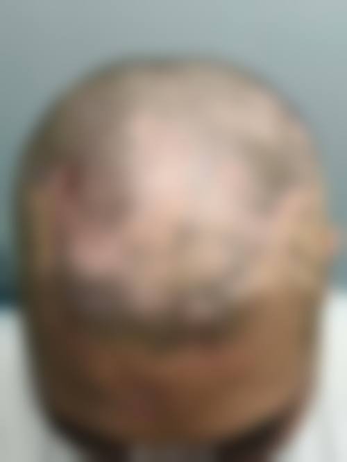 成都恒博植发植发专科医院求美者反馈