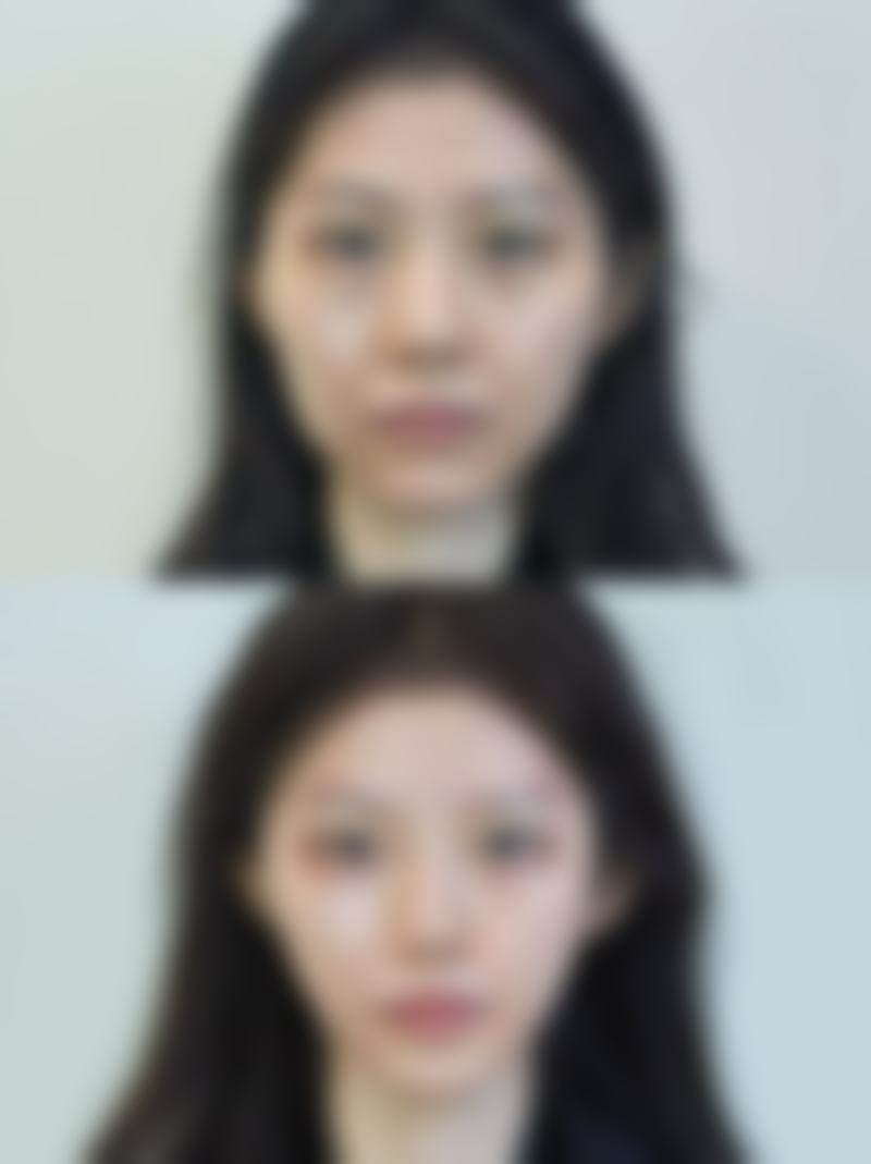 金永民医生领衔的特色鼻整形技术：鼻尖矫正与修复手术