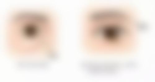 黄奎植院长主推的两大核心鼻整形技术