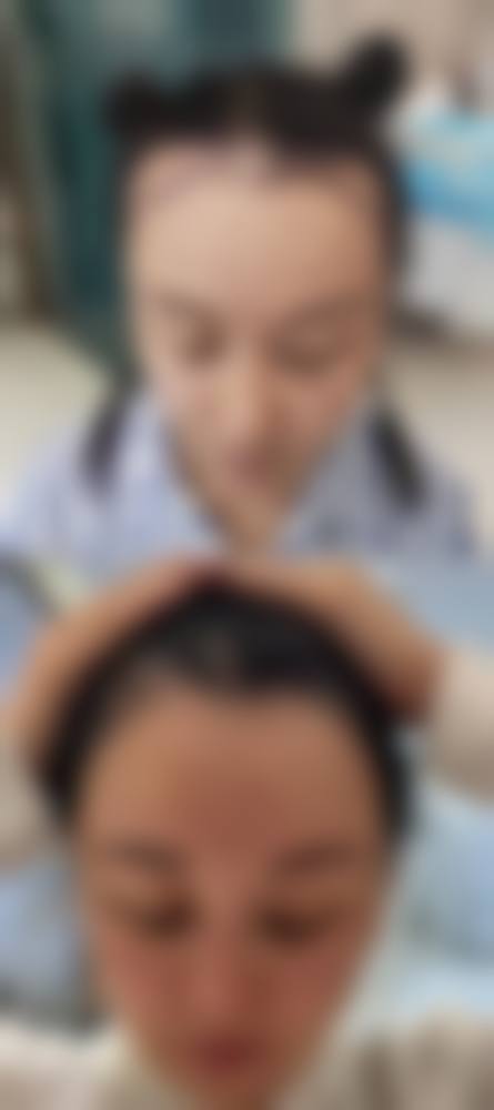 米圣主治医师常用的两大精良无痕植发技术