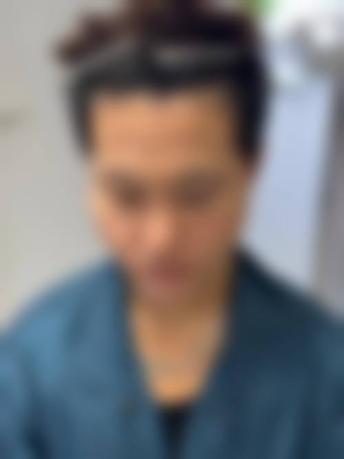 植发项目收费参考