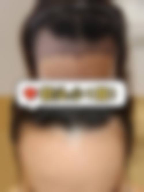黄兆全医生的诊疗贴合不同患者的毛发困扰