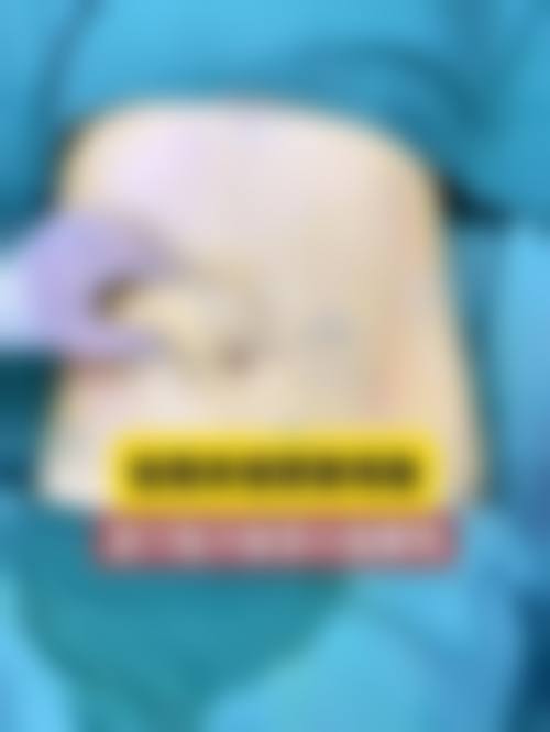 张解生医生诊疗的正规安心保护