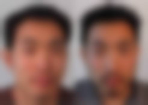 冯庆亮医生擅长的自体脂肪精细化雕刻特色项目