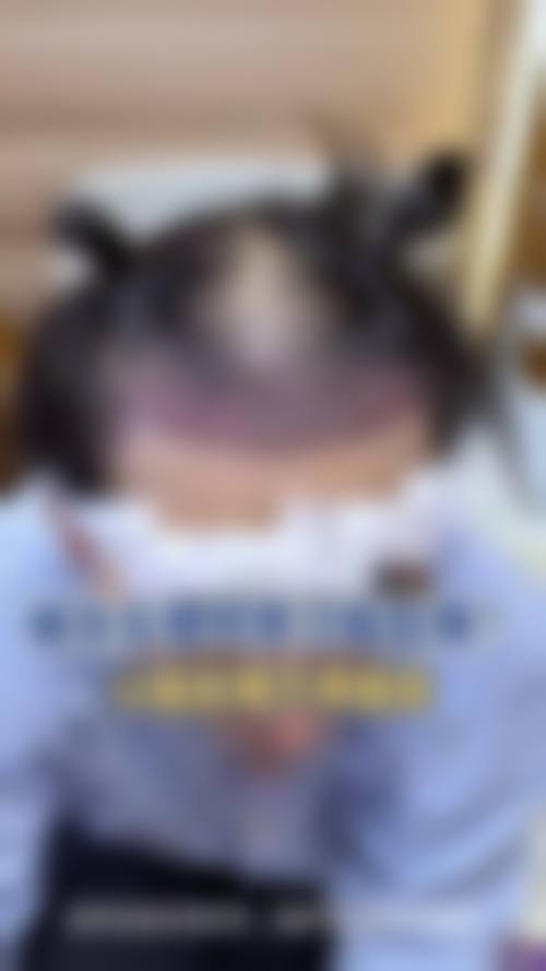 北京大麦微针植发医院求美者反馈