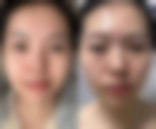 韩国傲婷美(OPTIMA)整形外科医院求美者反馈