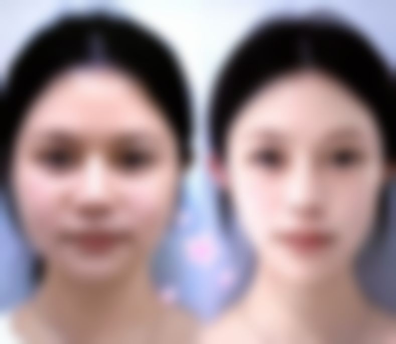 韩国BarbieFace整形医院价格收费