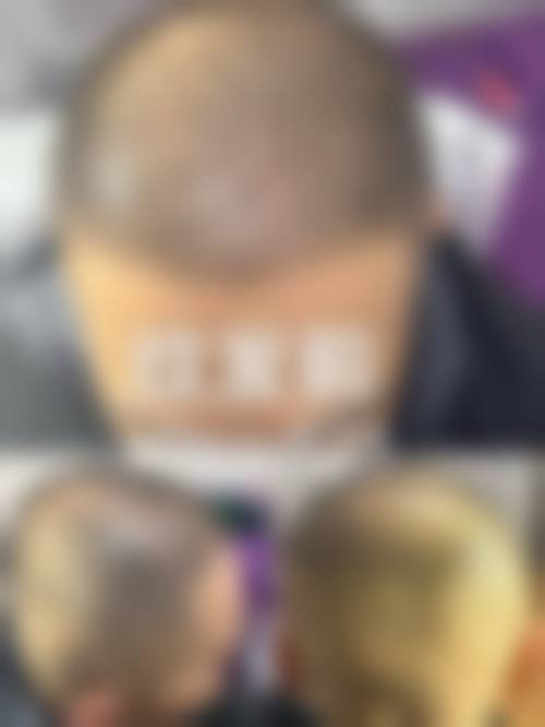 黄兆全医生可开展的专精毛发健康服务项目